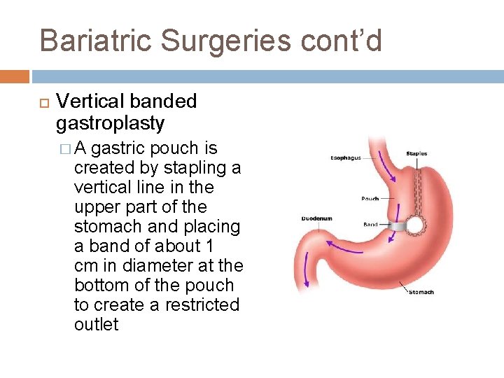 Bariatric Surgeries cont’d Vertical banded gastroplasty �A gastric pouch is created by stapling a