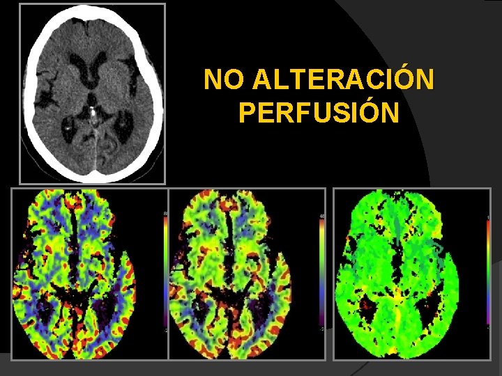 NO ALTERACIÓN PERFUSIÓN 