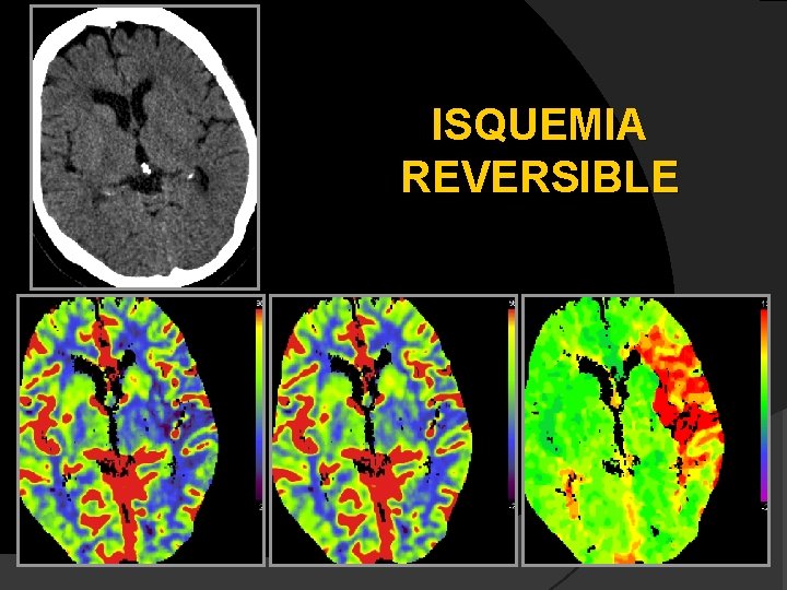 ISQUEMIA REVERSIBLE 