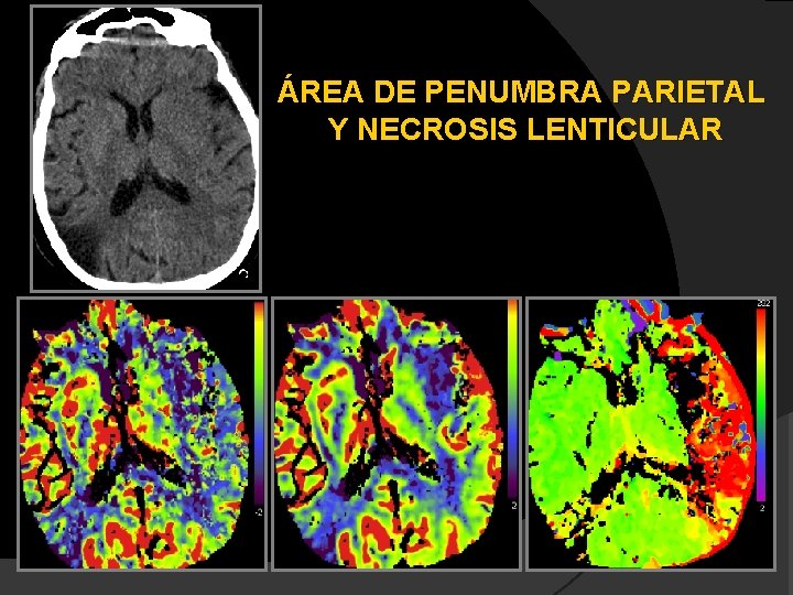ÁREA DE PENUMBRA PARIETAL Y NECROSIS LENTICULAR 