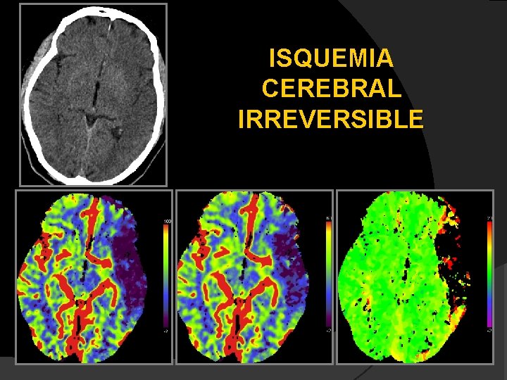 ISQUEMIA CEREBRAL IRREVERSIBLE 