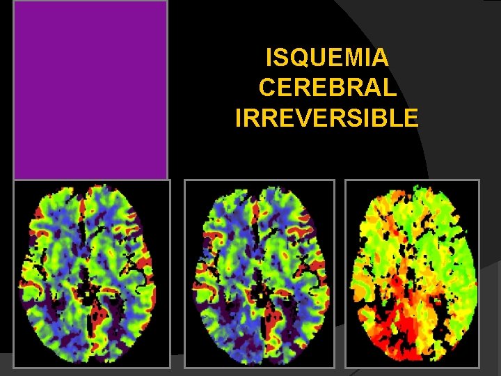 ISQUEMIA CEREBRAL IRREVERSIBLE 