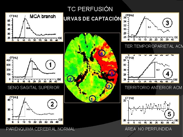 TC PERFUSIÓN CURVAS DE CAPTACIÓN TER. TEMPOROPARIETAL ACM 4 5 2 3 SENO SAGITAL