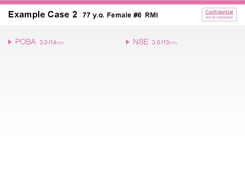 Example Case 2 POBA 3. 0 /14 mm 77 y. o. Female #6 RMI