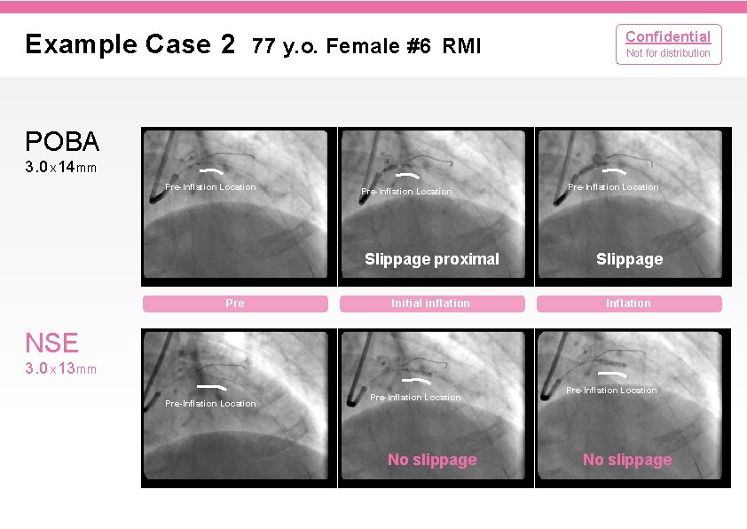 Example Case 2 77 y. o. Female #6 RMI Confidential Not for distribution POBA