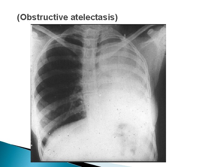 (Obstructive atelectasis) 