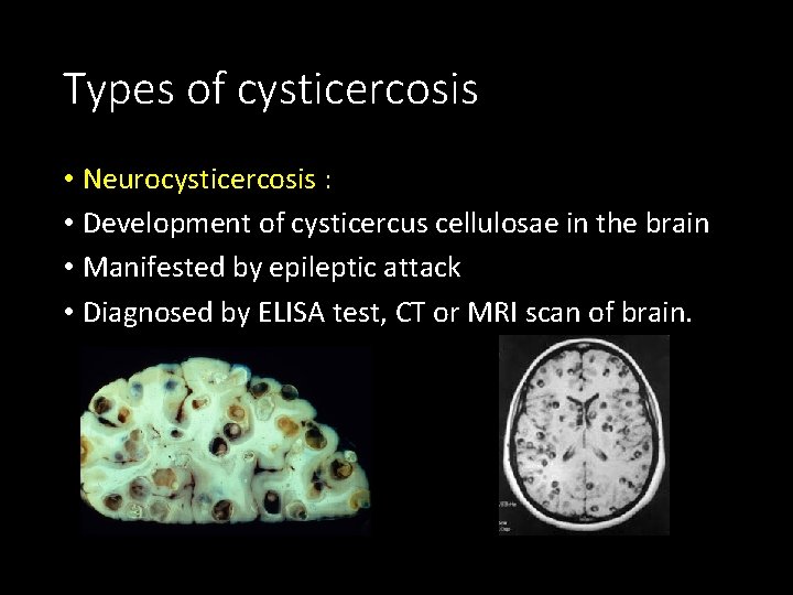 Types of cysticercosis • Neurocysticercosis : • Development of cysticercus cellulosae in the brain