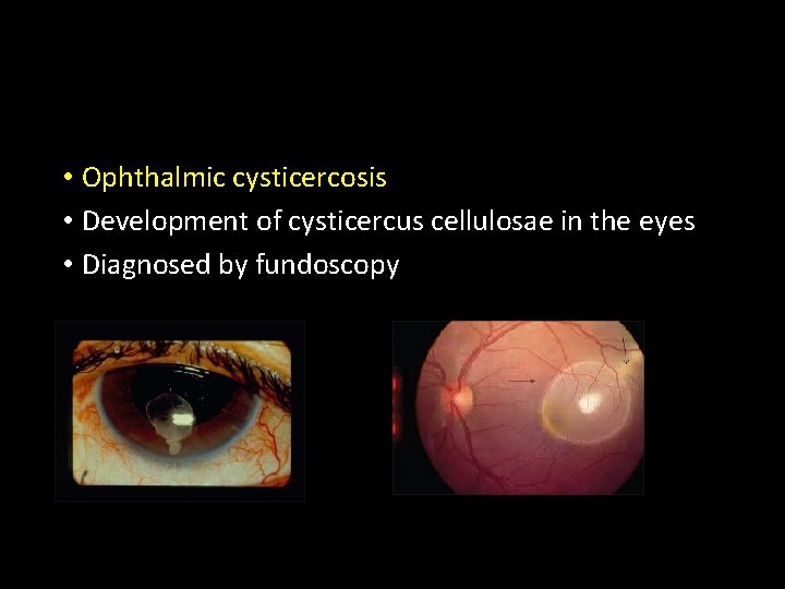  • Ophthalmic cysticercosis • Development of cysticercus cellulosae in the eyes • Diagnosed