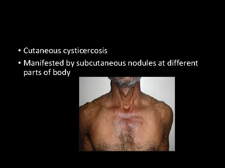  • Cutaneous cysticercosis • Manifested by subcutaneous nodules at different parts of body