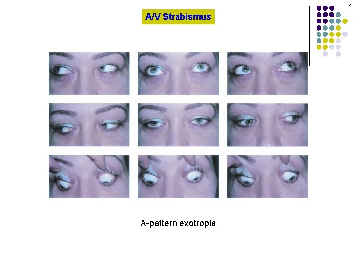 2 A/V Strabismus A-pattern exotropia 
