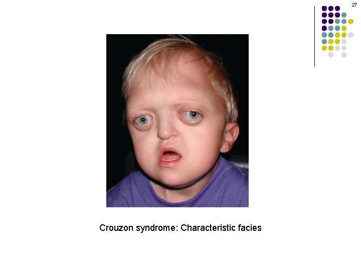 27 Crouzon syndrome: Characteristic facies 