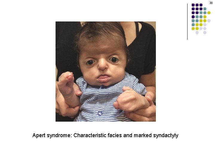 30 Apert syndrome: Characteristic facies and marked syndactyly 