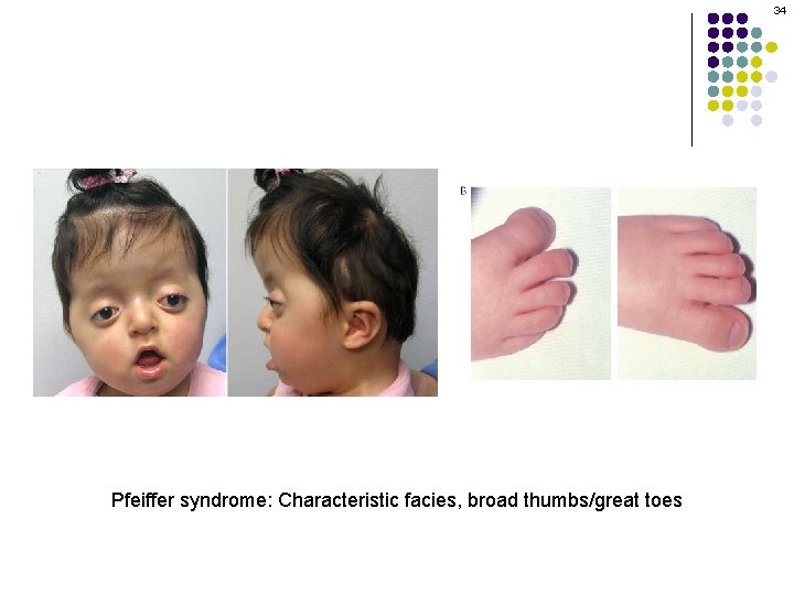 34 Pfeiffer syndrome: Characteristic facies, broad thumbs/great toes 