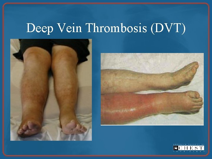 Deep Vein Thrombosis (DVT) 