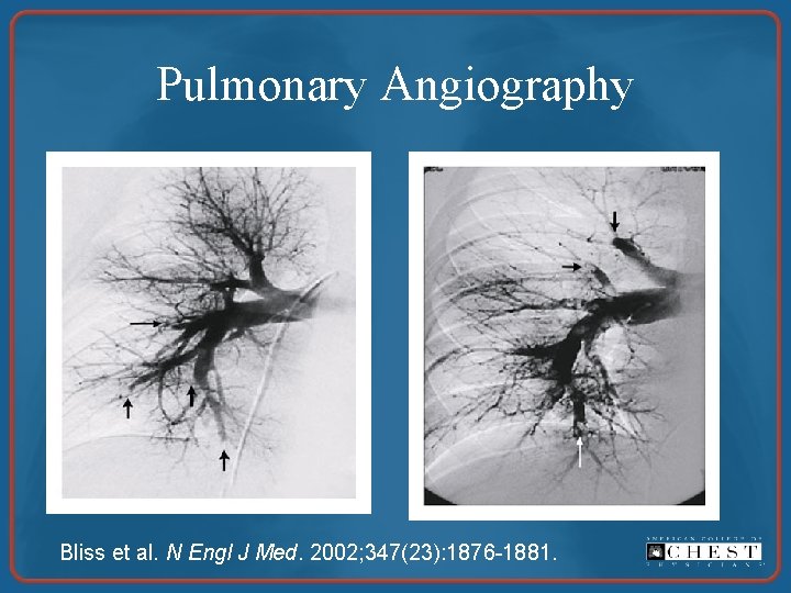 Pulmonary Angiography Bliss et al. N Engl J Med. 2002; 347(23): 1876 -1881. 