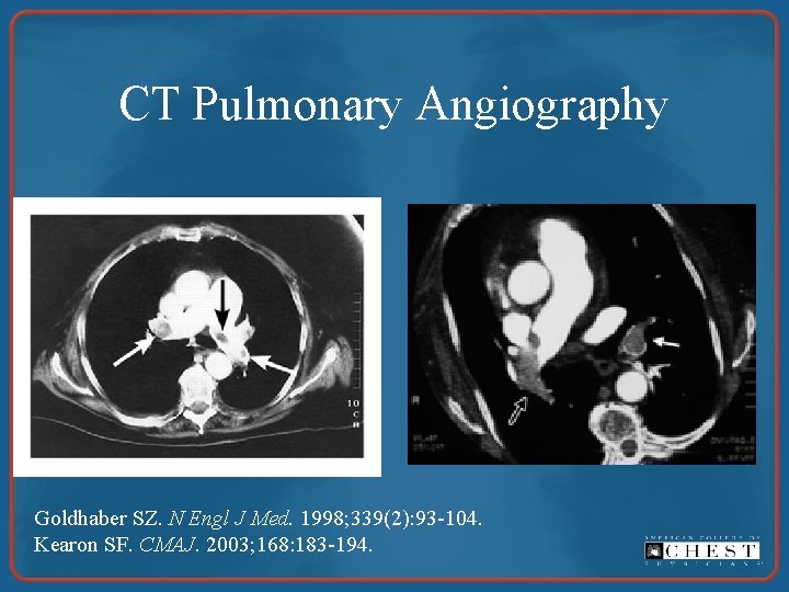 CT Pulmonary Angiography Goldhaber SZ. N Engl J Med. 1998; 339(2): 93 -104. Kearon