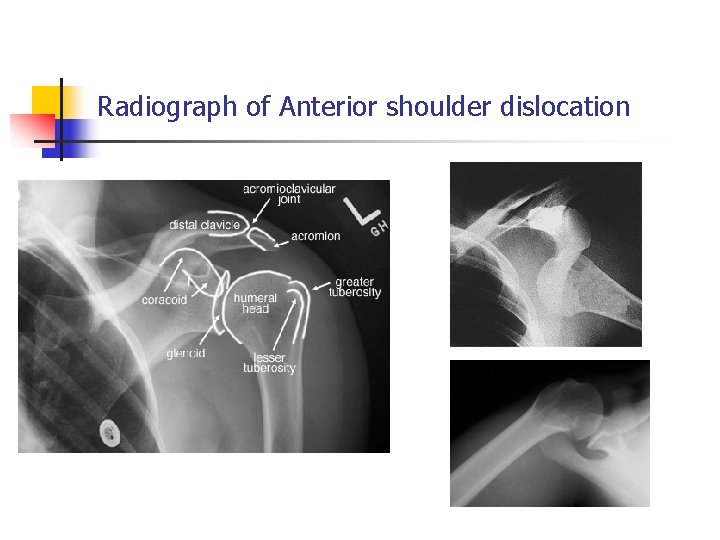 Radiograph of Anterior shoulder dislocation 