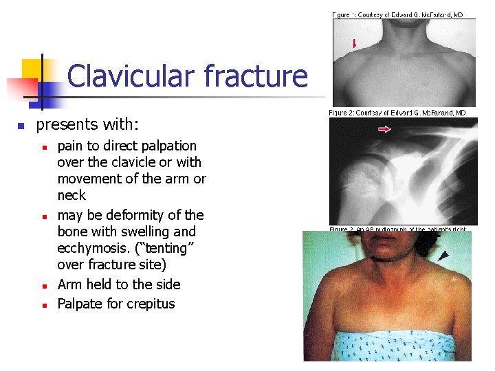 Clavicular fracture n presents with: n n pain to direct palpation over the clavicle