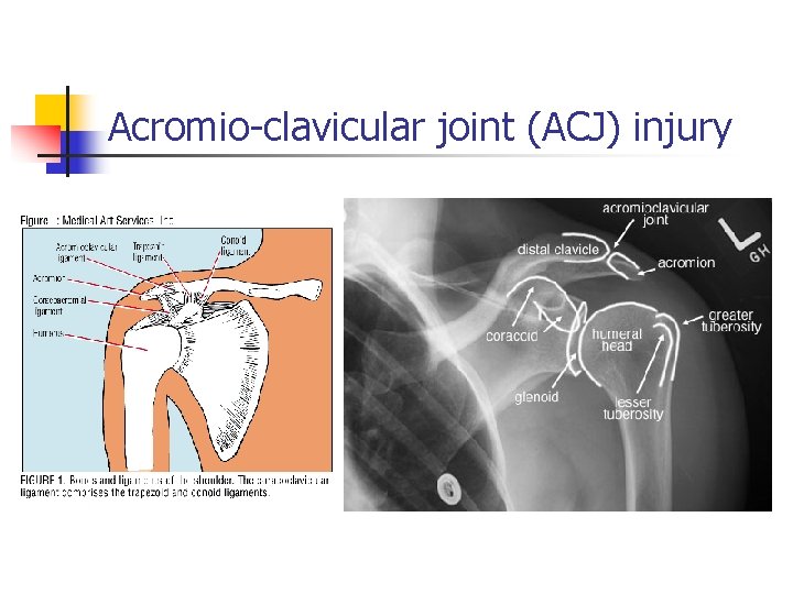 Acromio-clavicular joint (ACJ) injury 