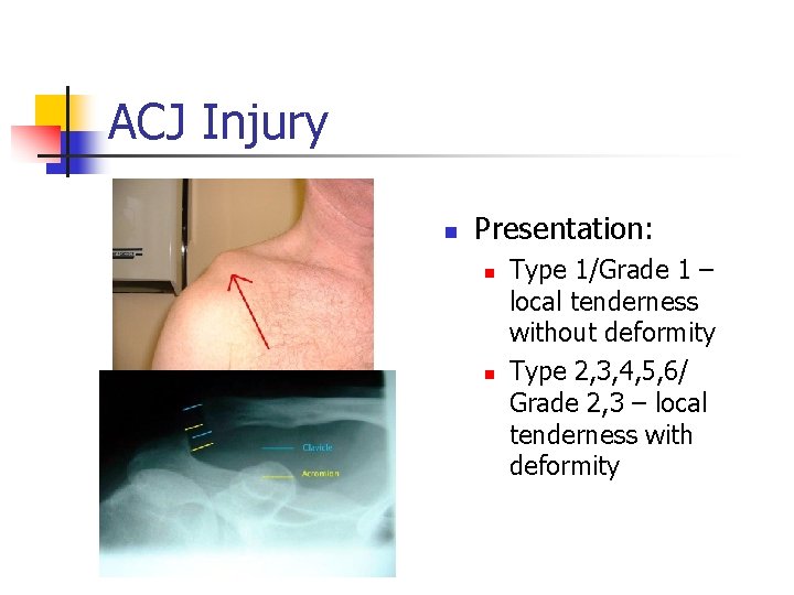 ACJ Injury n Presentation: n n Type 1/Grade 1 – local tenderness without deformity