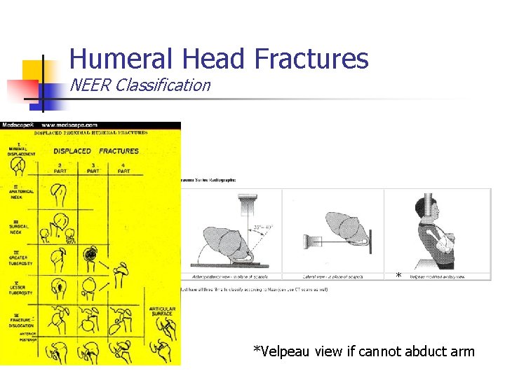 Humeral Head Fractures NEER Classification * *Velpeau view if cannot abduct arm 