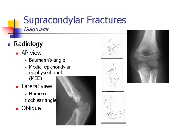 Supracondylar Fractures Diagnosis n Radiology n AP view n n n Baumann’s angle Medial
