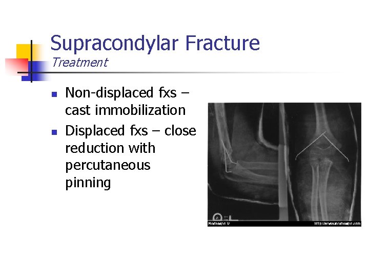 Supracondylar Fracture Treatment n n Non-displaced fxs – cast immobilization Displaced fxs – close