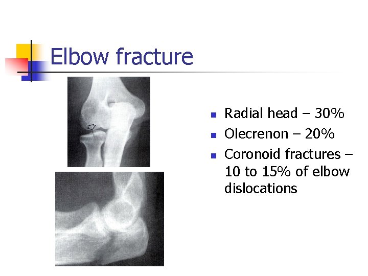 Elbow fracture n n n Radial head – 30% Olecrenon – 20% Coronoid fractures