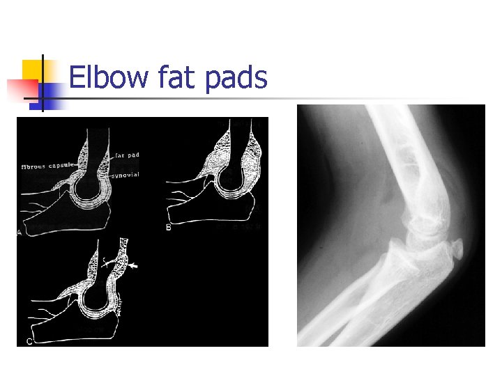 Elbow fat pads 