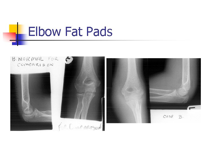 Elbow Fat Pads 