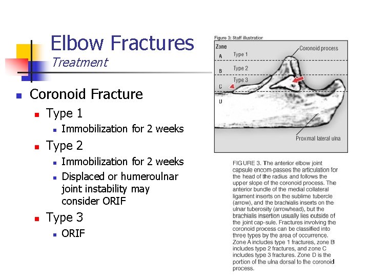 Elbow Fractures Treatment n Coronoid Fracture n Type 1 n n Type 2 n