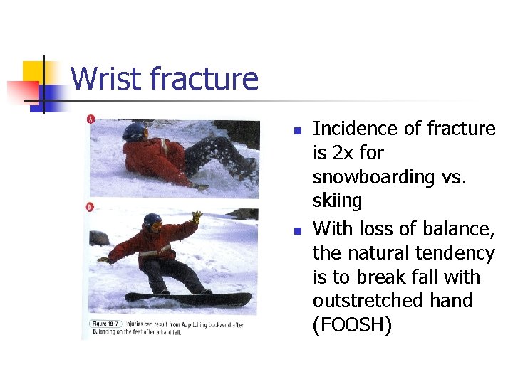 Wrist fracture n n Incidence of fracture is 2 x for snowboarding vs. skiing