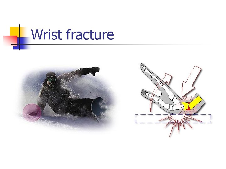 Wrist fracture 
