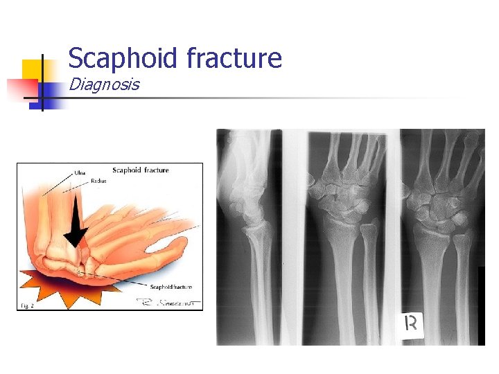 Scaphoid fracture Diagnosis 