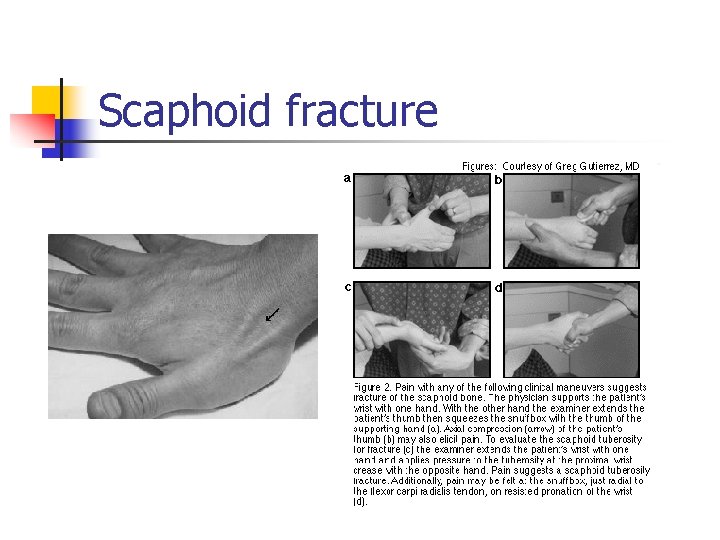 Scaphoid fracture 