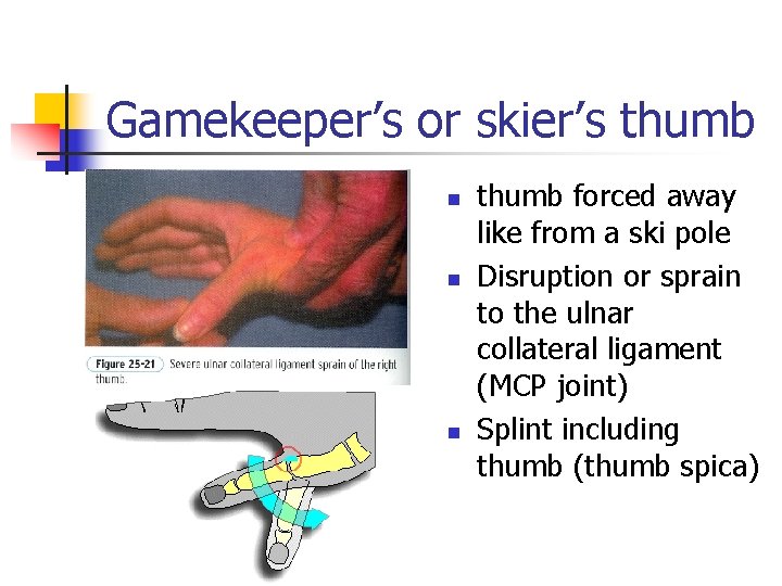 Gamekeeper’s or skier’s thumb n n n thumb forced away like from a ski