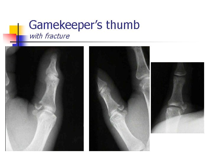 Gamekeeper’s thumb with fracture 
