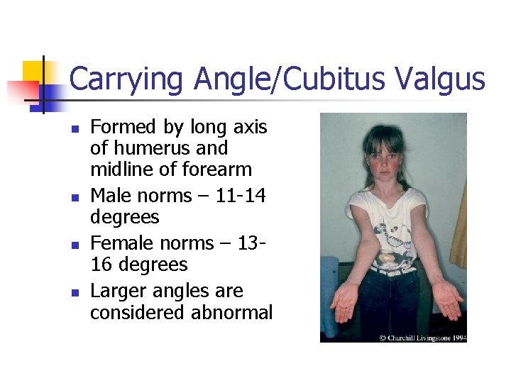 Carrying Angle/Cubitus Valgus n n Formed by long axis of humerus and midline of