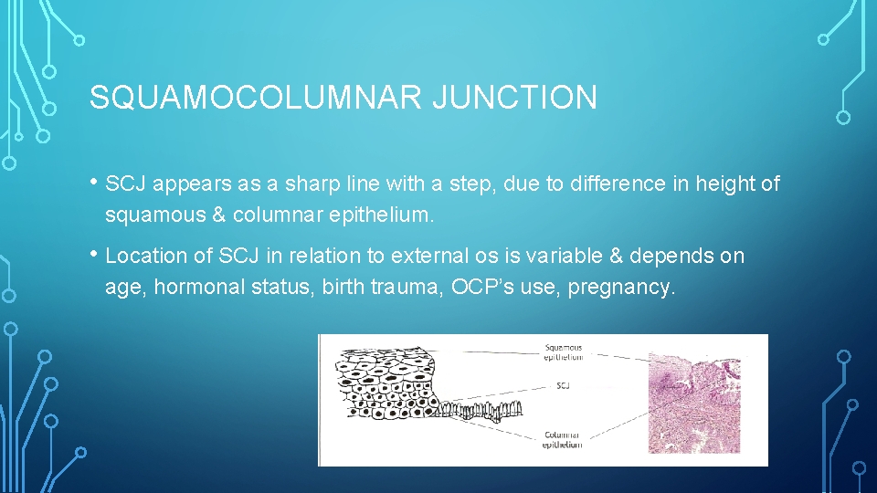 SQUAMOCOLUMNAR JUNCTION • SCJ appears as a sharp line with a step, due to