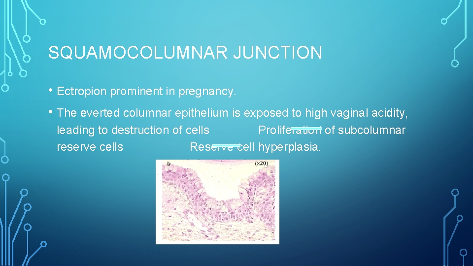 SQUAMOCOLUMNAR JUNCTION • Ectropion prominent in pregnancy. • The everted columnar epithelium is exposed