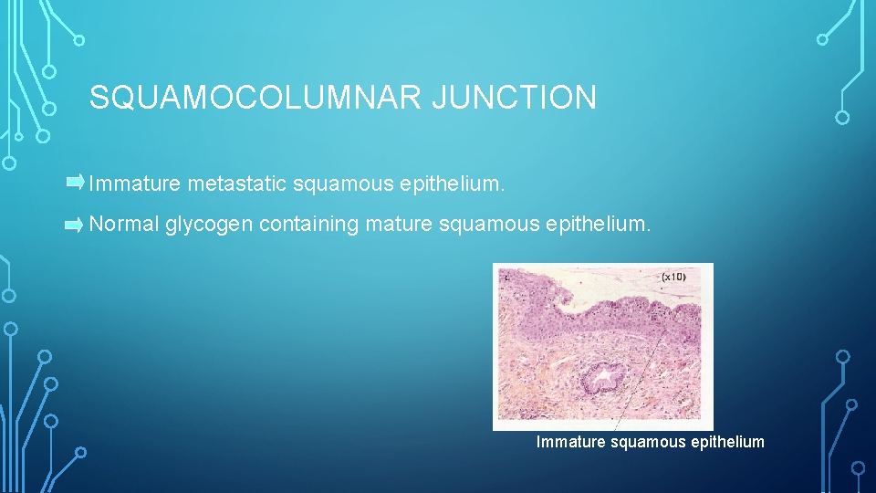 SQUAMOCOLUMNAR JUNCTION Immature metastatic squamous epithelium. Normal glycogen containing mature squamous epithelium. Immature squamous