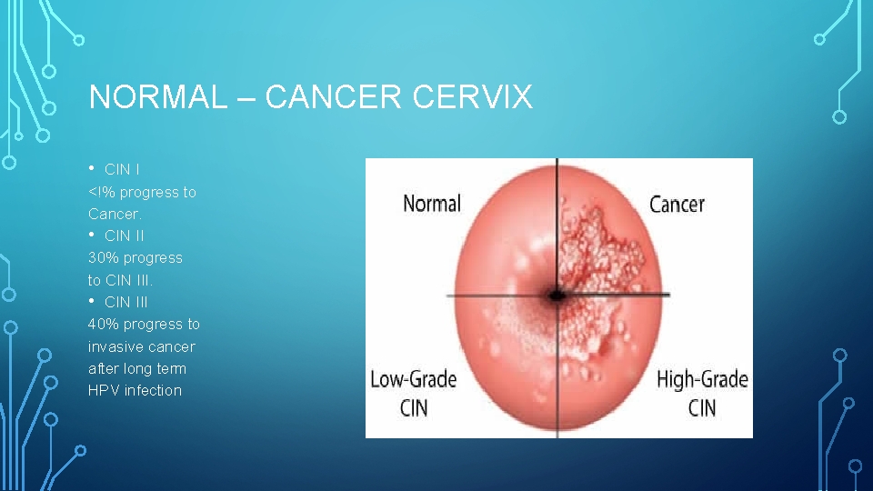 NORMAL – CANCER CERVIX • CIN I <!% progress to Cancer. • CIN II