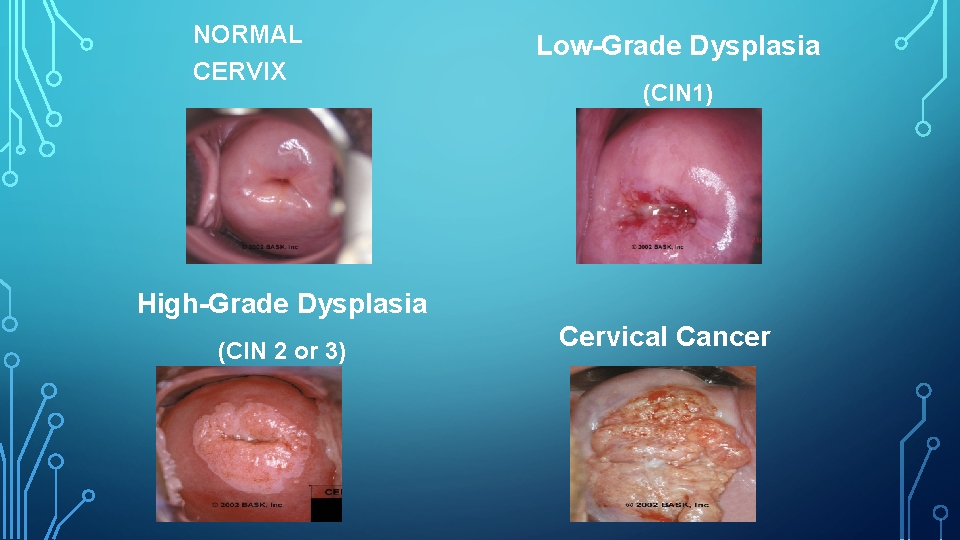 NORMAL CERVIX Low-Grade Dysplasia (CIN 1) High-Grade Dysplasia (CIN 2 or 3) Cervical Cancer