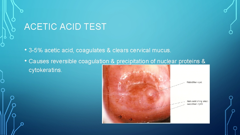 ACETIC ACID TEST • 3 -5% acetic acid, coagulates & clears cervical mucus. •