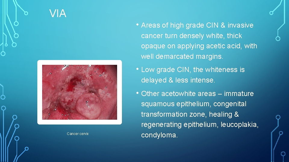 VIA • Areas of high grade CIN & invasive cancer turn densely white, thick