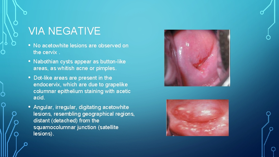 VIA NEGATIVE • No acetowhite lesions are observed on the cervix. • Nabothian cysts