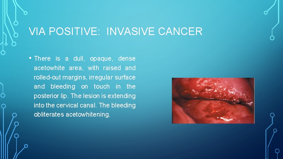 VIA POSITIVE: INVASIVE CANCER • There is a dull, opaque, dense acetowhite area, with