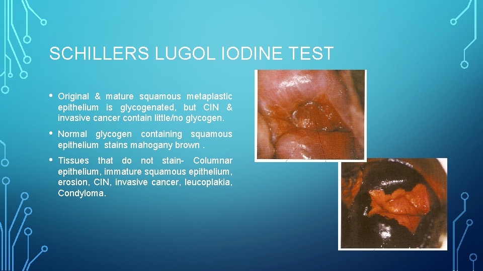 SCHILLERS LUGOL IODINE TEST • Original & mature squamous metaplastic epithelium is glycogenated, but