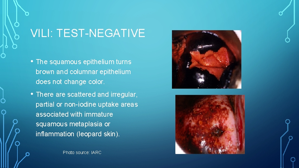 VILI: TEST-NEGATIVE • The squamous epithelium turns brown and columnar epithelium does not change