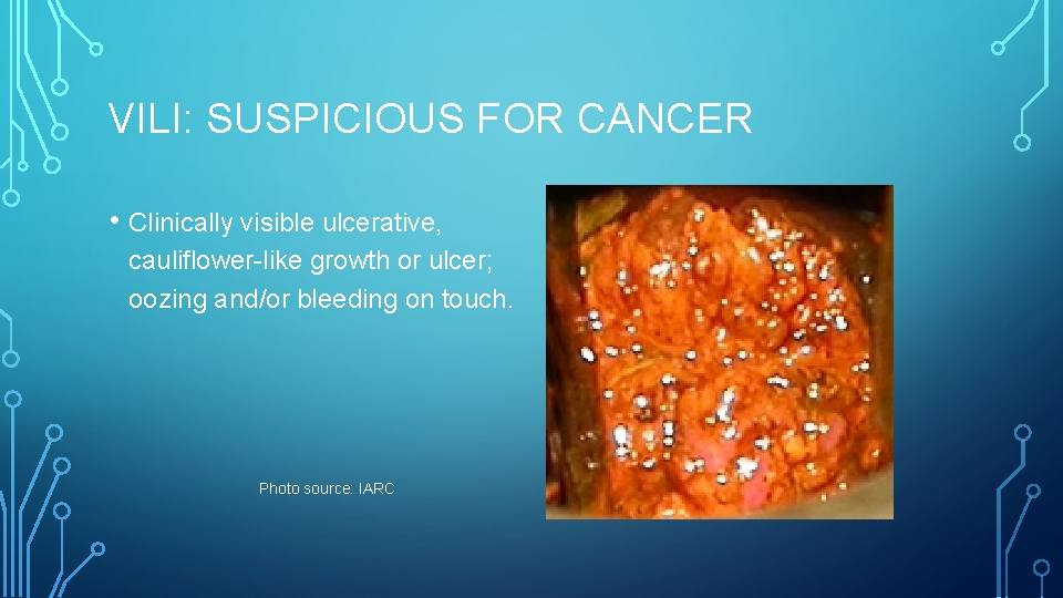 VILI: SUSPICIOUS FOR CANCER • Clinically visible ulcerative, cauliflower-like growth or ulcer; oozing and/or